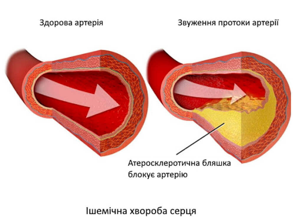 Діагностика та лікування ішемічної хвороби серця